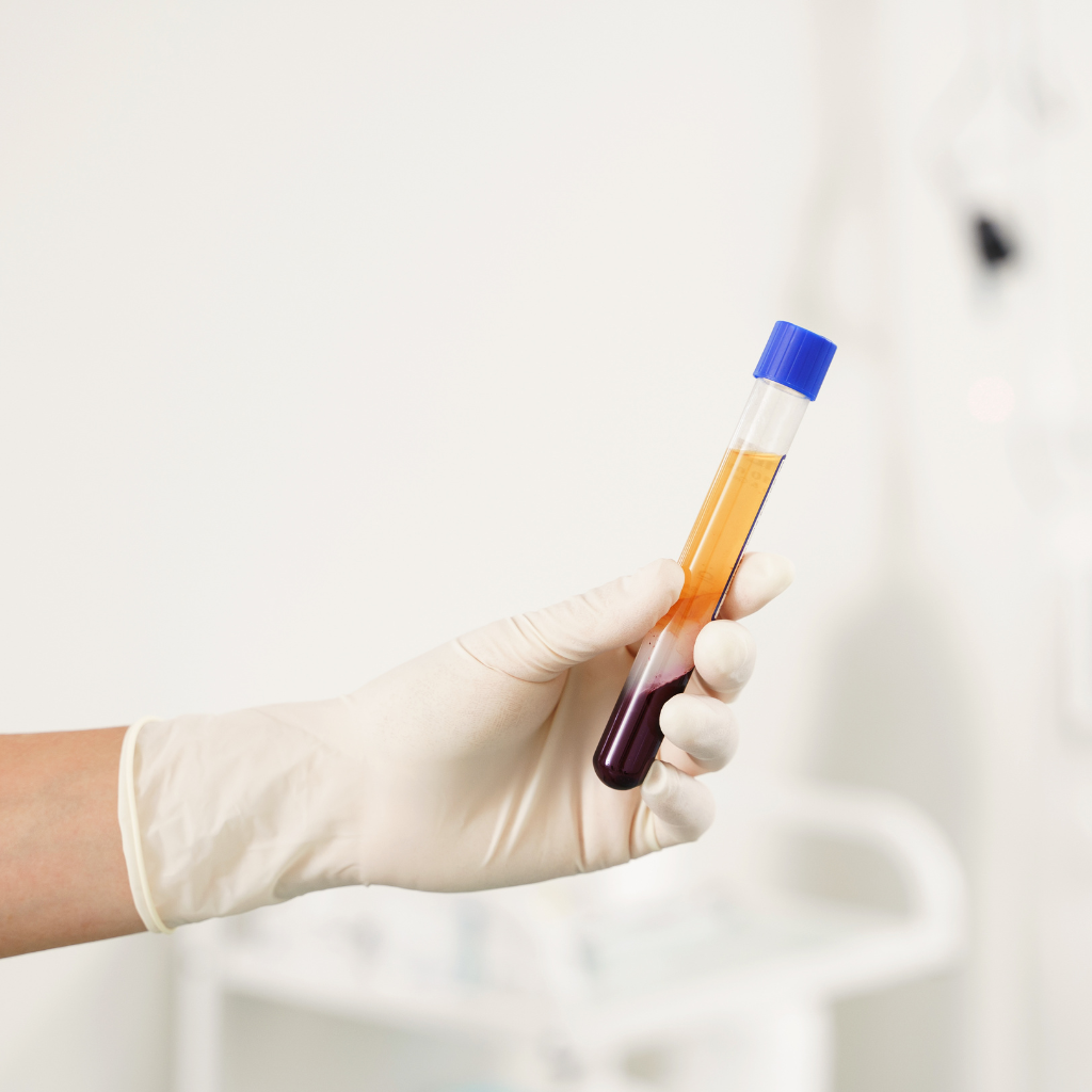 PRP in Tricologia: Una Rivoluzione per i Tuoi Capelli